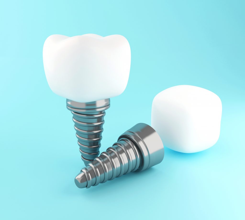 Tooth Implant