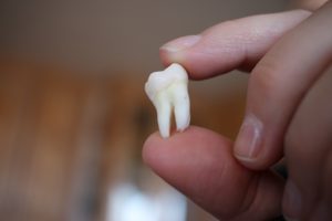 Wisdom Teeth Removal Cost