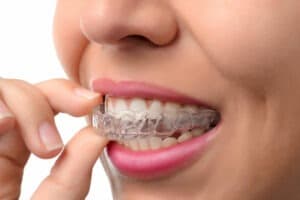 invisalign dental clinic